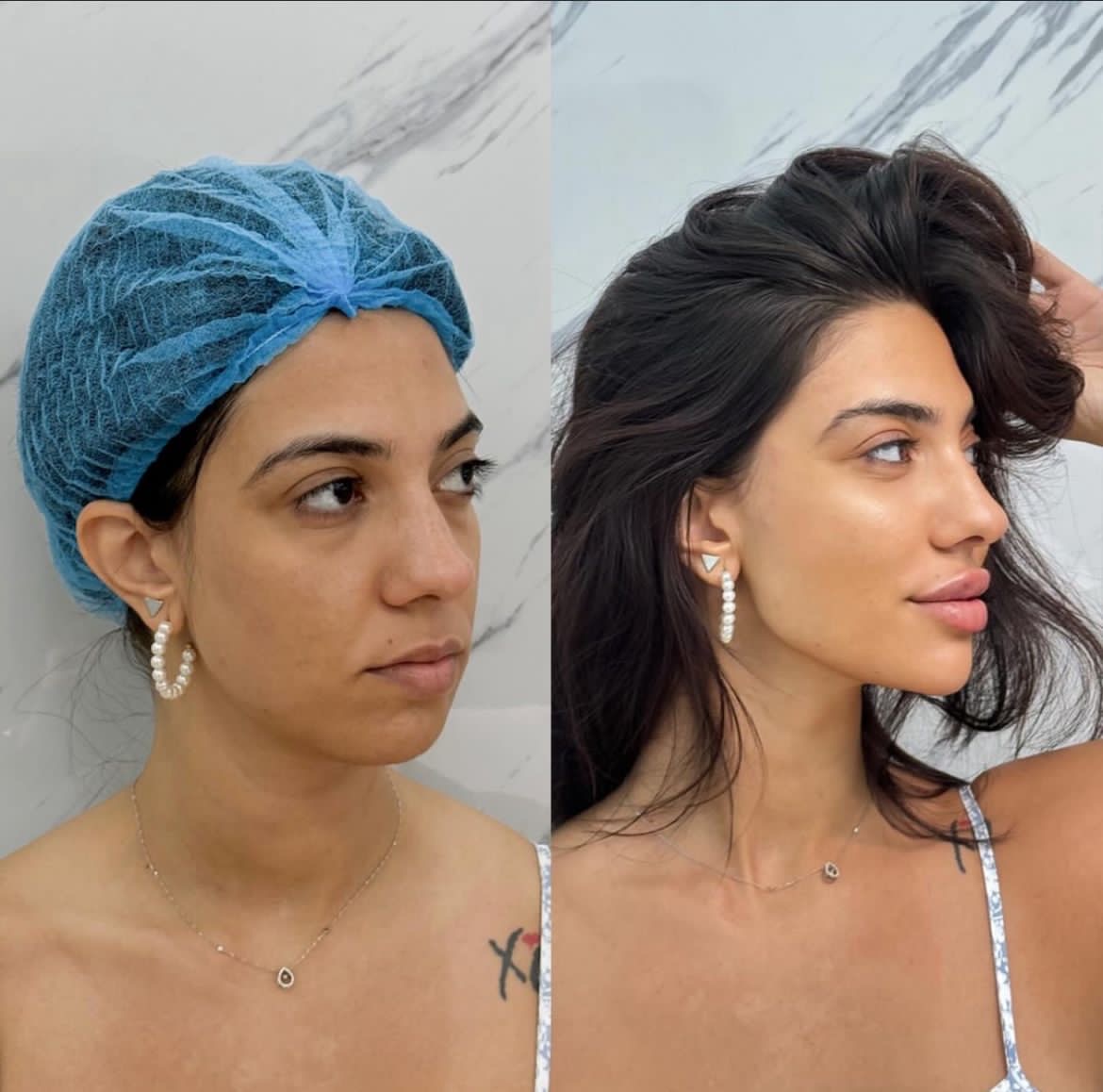 Profile filler transformation