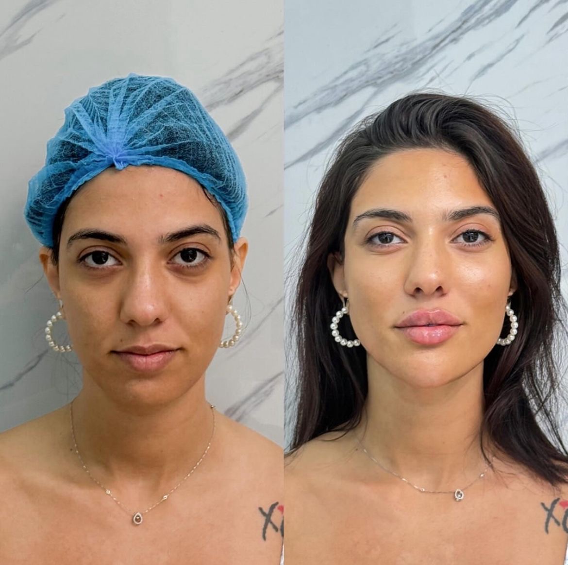 Facial aesthetic transformation