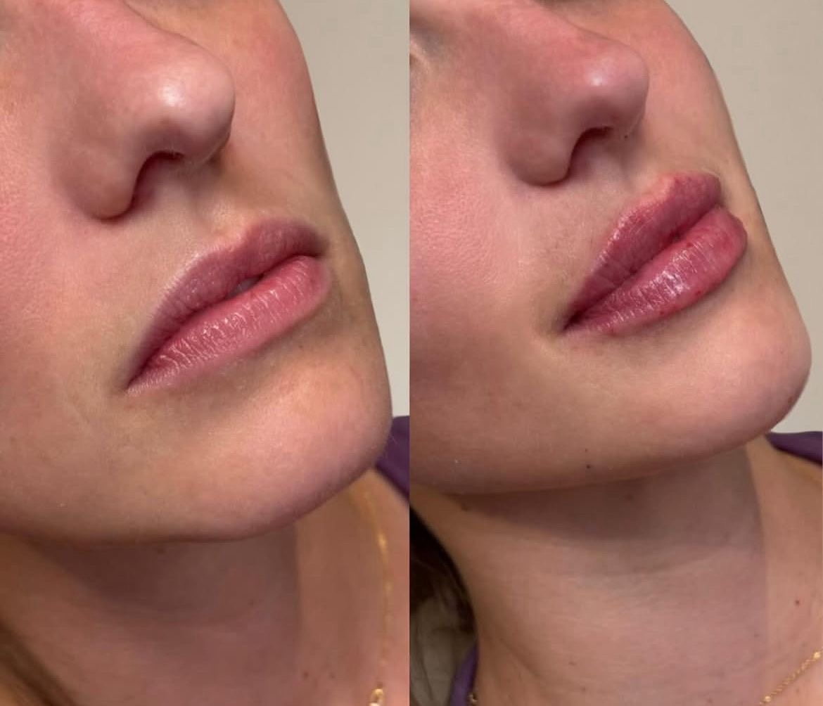 Lip filler before and after